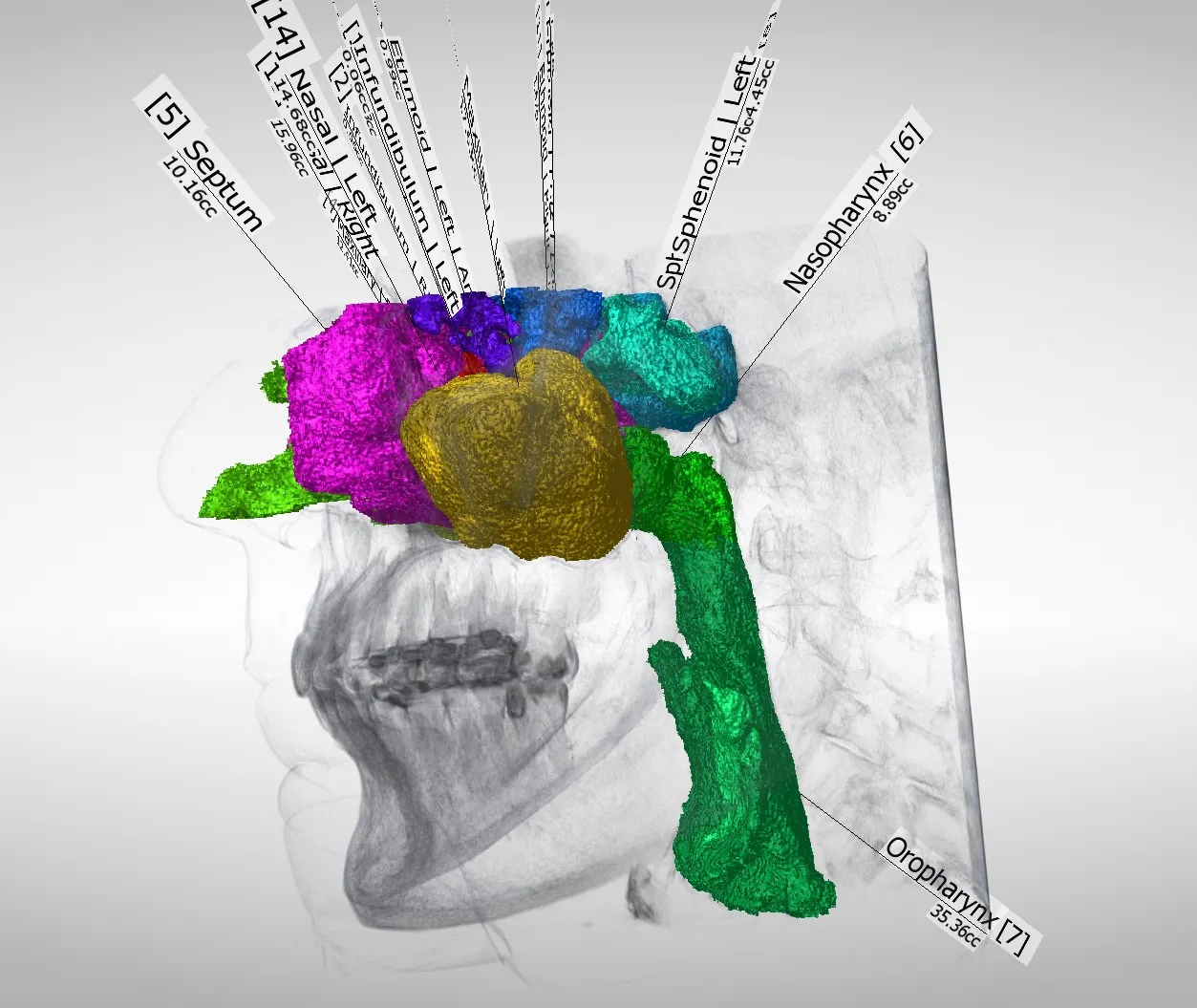 3D rendering of airway and sinus anatomy 3D segmentation from cone beam CT scan